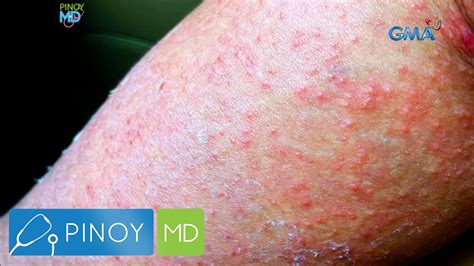 underarm rashes sa kilikili|Mga Karaniwang Pantal na Matatagpuan sa Kili.